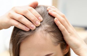 young woman with hair loss