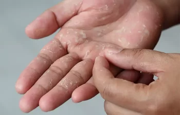 How To Get Nail Glue Off Skin